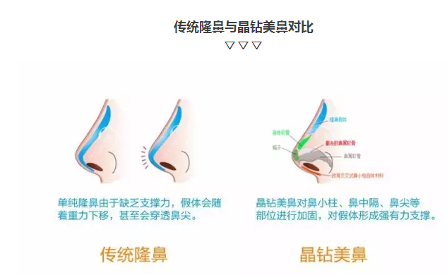 鼻整形对比图