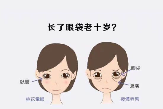 去眼袋手术能维持几年?看完惊呆了!