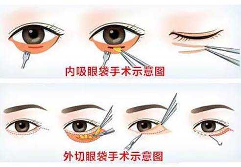 眼袋手术效果能维持多久?和这4个因素有关_