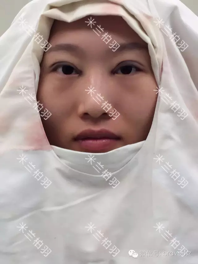 小凤 美杜莎精雕重睑术 7天就能电力十足