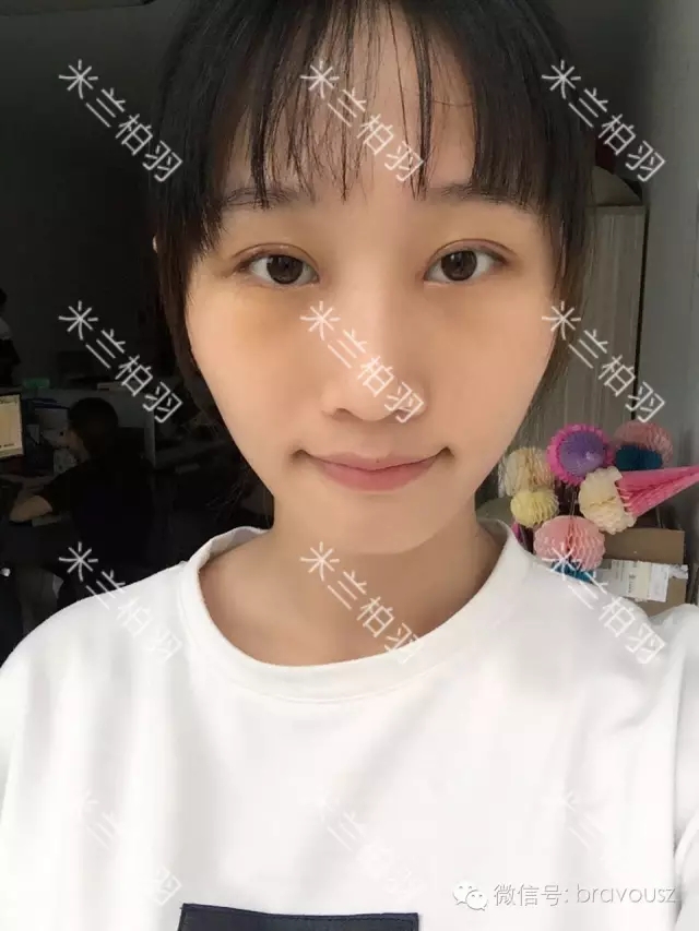 小凤 美杜莎精雕重睑术 7天就能电力十足